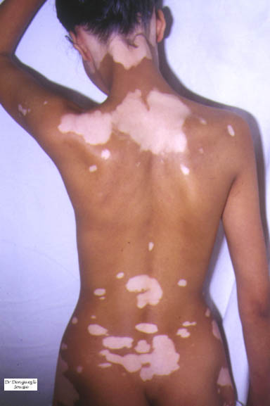 vitiligo01.jpg